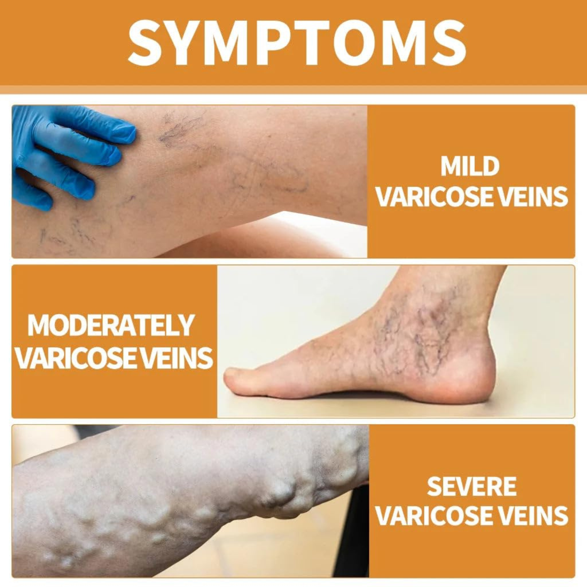 GoReady® Varicose Veins Spray – Natural Herbal Relief Reduces Swelling, Relieves Pain Spray  (30 ml)