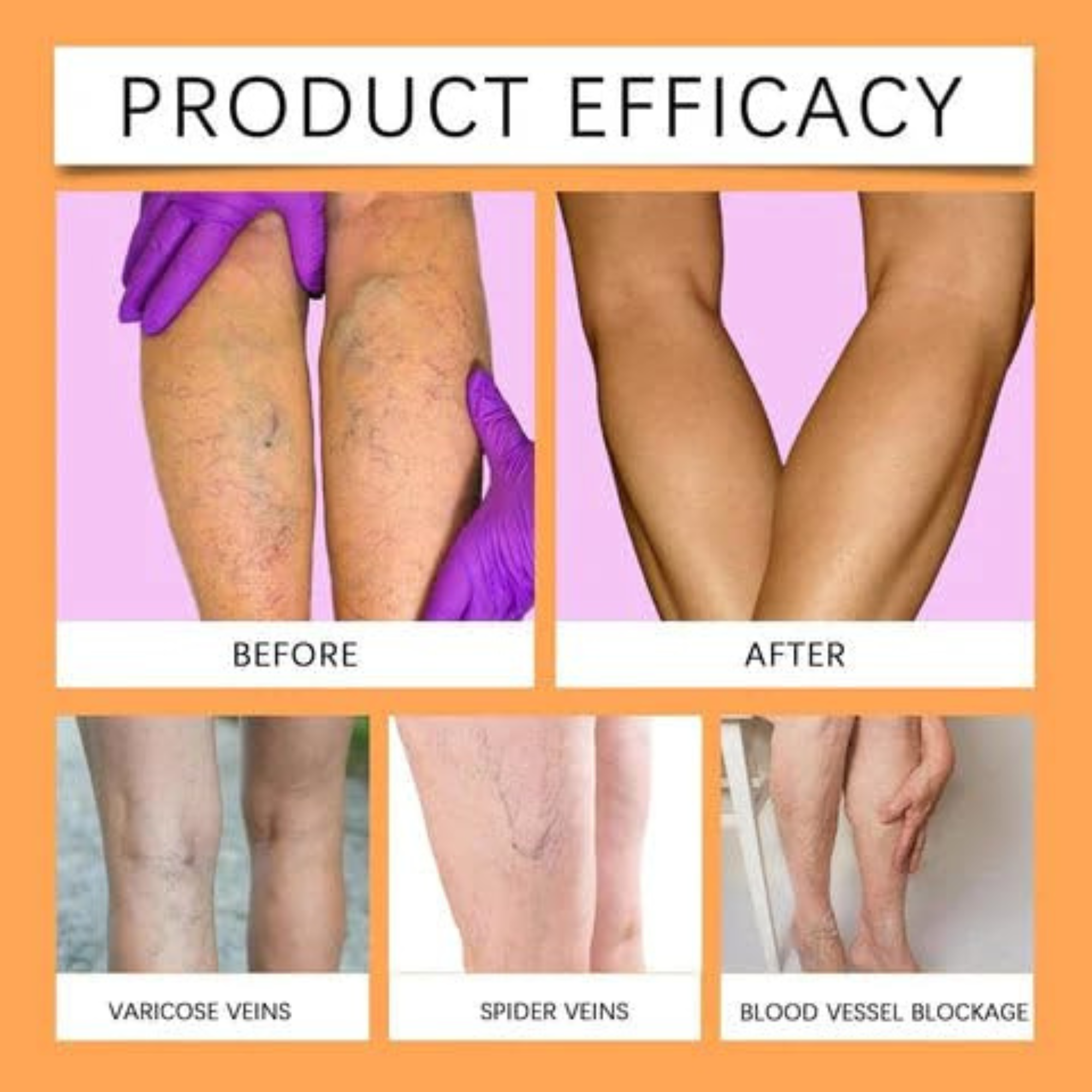 GoReady® Varicose Veins Spray – Natural Herbal Relief Reduces Swelling, Relieves Pain Spray  (30 ml)